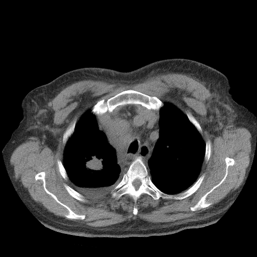 Bronchogenic carcinoma with metastatic lymphadenopathy (Radiopaedia 37671-39569 Axial non-contrast 13).jpg