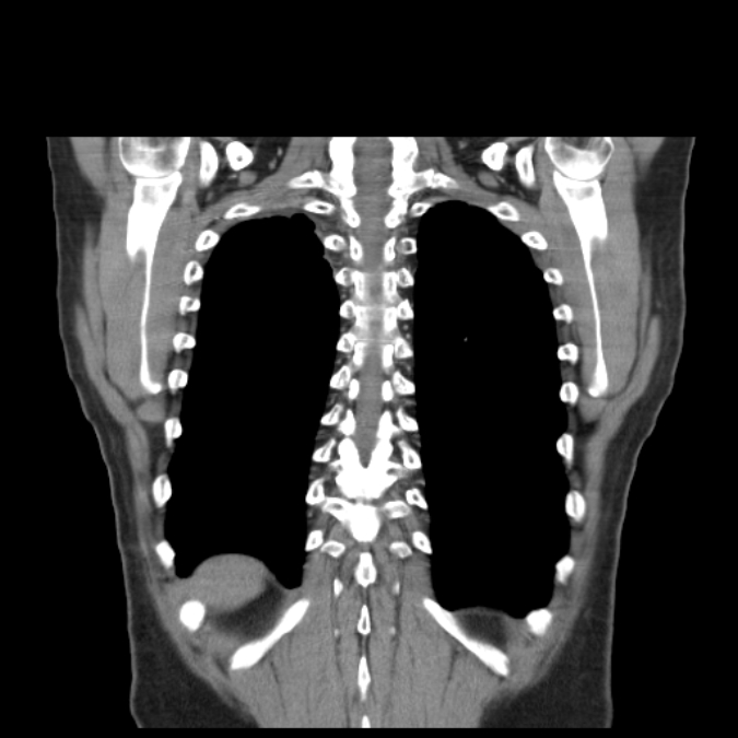 Bronchogenic carcinoma with upper lobe collapse (Radiopaedia 29297-29726 D 45).jpg