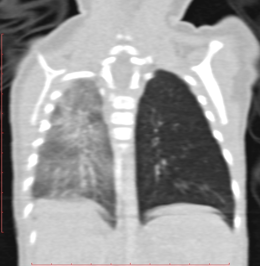 Bronchogenic cyst (Radiopaedia 78599-91409 Coronal lung window 163).jpg