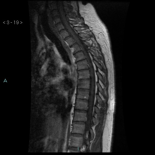File:Bronchogenic cyst - posterior mediastinal (Radiopaedia 43885-47365 Sagittal T1 19).jpg