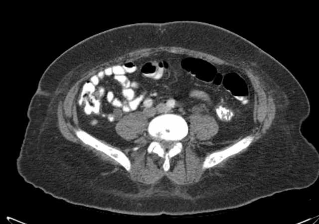 Brown tumors compressing the spinal cord (Radiopaedia 68442-77988 E 80).jpg