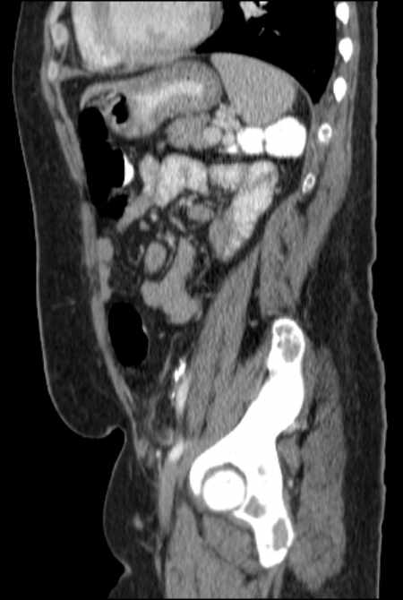 Brown tumors compressing the spinal cord (Radiopaedia 68442-77988 F 39).jpg