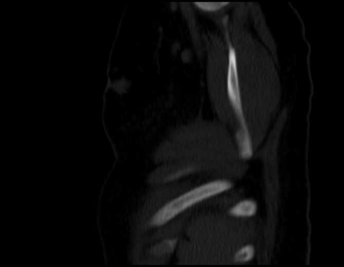 Brown tumors compressing the spinal cord (Radiopaedia 68442-77988 Sagittal bone window 54).jpg
