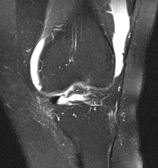 File:Bucket handle tear - medial meniscus (Radiopaedia 79028-91942 Coronal PD fat sat 16).jpg