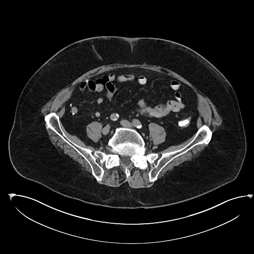 File:Buried bumper syndrome - gastrostomy tube (Radiopaedia 63843-72577 Axial Inject 84).jpg