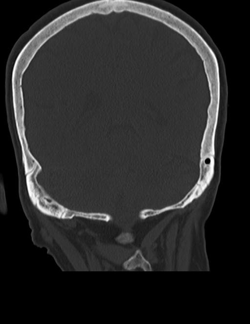 Burnt-out meningioma (Radiopaedia 51557-57337 Coronal bone window 39).jpg