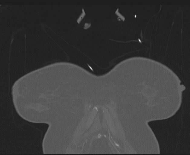 Burst fracture - thoracic spine (Radiopaedia 30238-30865 Coronal bone window 11).jpg