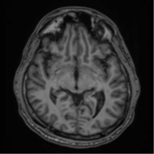 CNS vasculitis (Radiopaedia 55715-62263 Axial T1 20).png