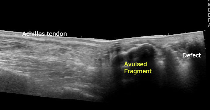 File:Calcaneal tuberosity avulsion fracture - ultrasound (Radiopaedia 29978-30524 Longitudinal 1).jpg