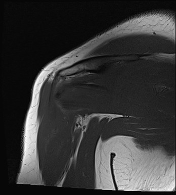 File:Calcific tendinitis of the infraspinatus tendon (Radiopaedia 87256-103537 Coronal T1 17).jpg