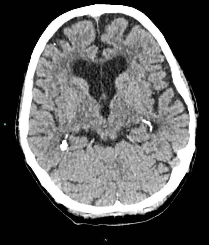 Calcified cerebral emboli from left ventricular thrombus (Radiopaedia 84420-99758 Axial non-contrast 56).jpg