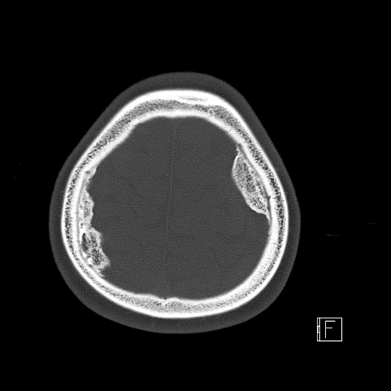 Calcified chronic subdural hematoma (Radiopaedia 77374-89492 Axial bone window 119).jpg