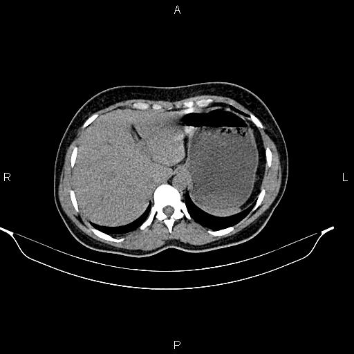 File:Calcified hepatic hydatid cyst (Radiopaedia 84672-100095 Axial non-contrast 22).jpg