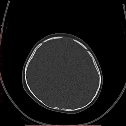 Calcified middle cerebral artery embolism (Radiopaedia 78949-91860 Axial bone window 59).jpg