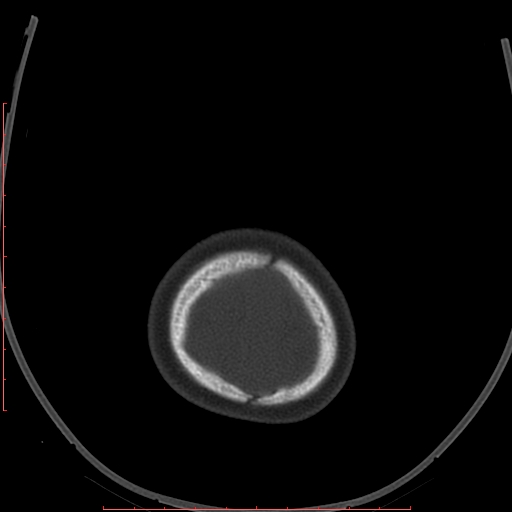 Calcified middle cerebral artery embolism (Radiopaedia 78949-91860 Axial bone window 69).jpg