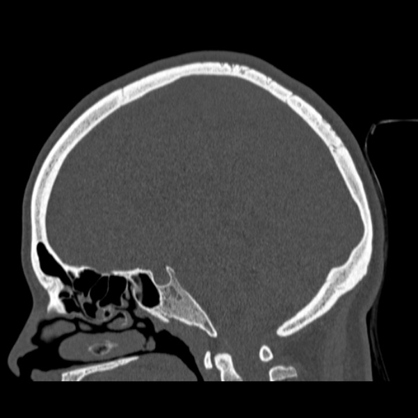 Calvarial osteoma (Radiopaedia 36520-38079 Sagittal bone window 53).jpg