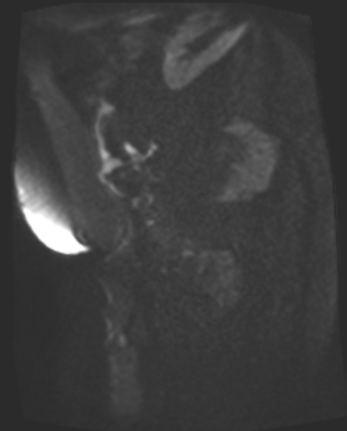 Cancer cervix - stage IIb (Radiopaedia 75411-86615 Sagittal DWI 72).jpg