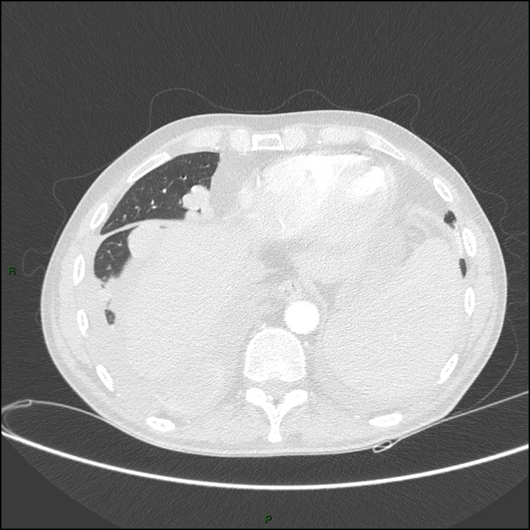 Cannonball metastases (Radiopaedia 82110-96150 Axial lung window 152).jpg