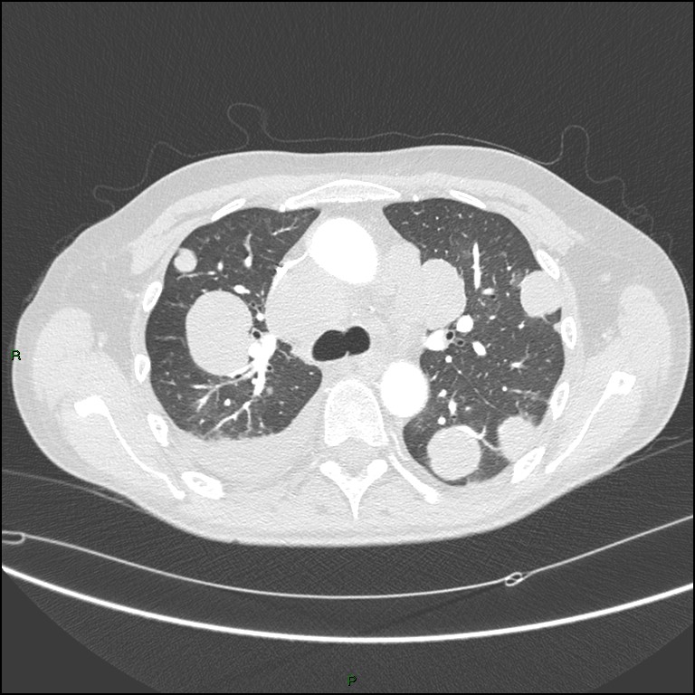 Cannonball metastases (Radiopaedia 82110-96150 Axial lung window 75).jpg