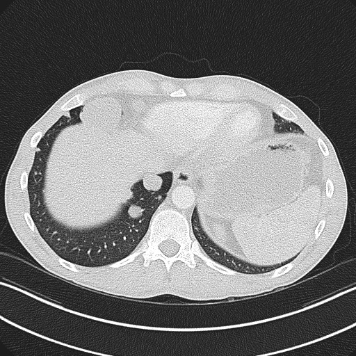 Cannonball metastases - testicular choriocarcinoma (Radiopaedia 84510-99891 Axial lung window 80).jpg