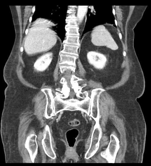 Cannonball metastases from endometrial cancer (Radiopaedia 42003-45031 F 47).png
