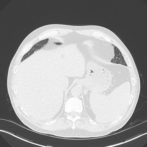 Caplan syndrome (Radiopaedia 56667-63530 Axial lung window 168).jpg