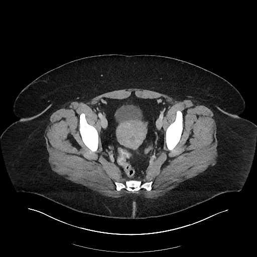 Carcinoid tumor - terminal ileum (Radiopaedia 60931-68739 A 117).jpg