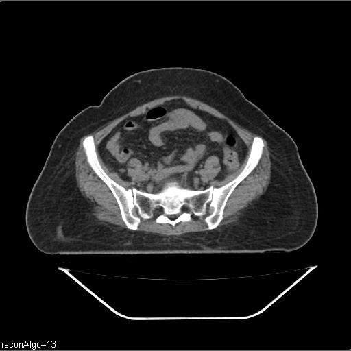 File:Carcinoma cervix- brachytherapy applicator (Radiopaedia 33135-34173 Axial non-contrast 10).jpg