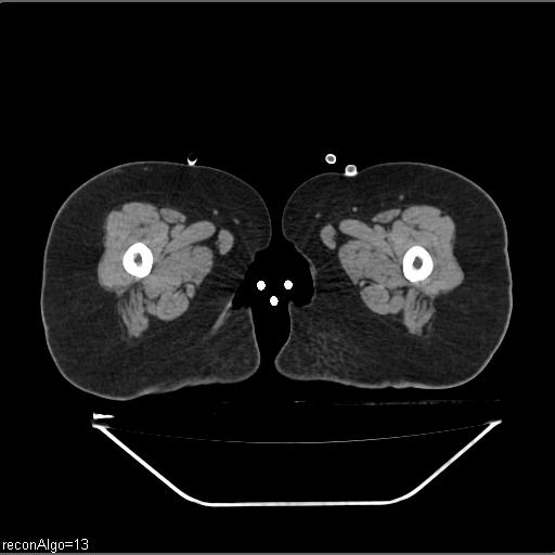 File:Carcinoma cervix- brachytherapy applicator (Radiopaedia 33135-34173 Axial non-contrast 72).jpg