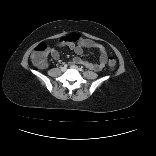 Carcinoma colon - hepatic flexure (Radiopaedia 19461-19493 A 84).jpg