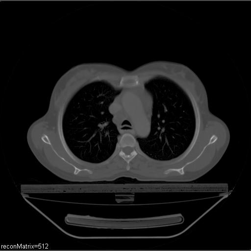 File:Carcinoma of esophagus (Radiopaedia 27356-27550 Axial bone window 23).jpg
