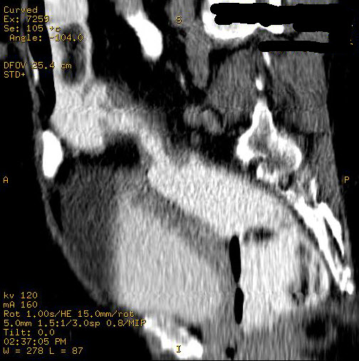 File:Carcinoma of sigmoid colon (Radiopaedia 23071-23100 D 3).jpg