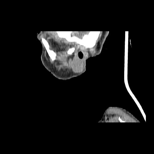 Carcinoma of the maxillary antrum (Radiopaedia 53805-59888 Sagittal C+ delayed 165).jpg