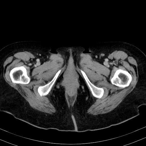 Carcinosarcoma (Radiopaedia 70401-80503 A 75).jpg