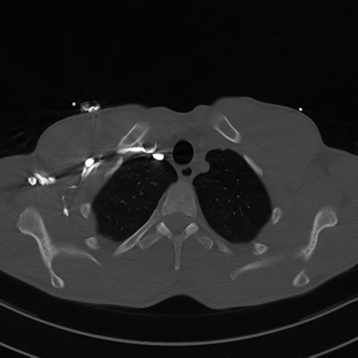 Cardiac tumor - undifferentiated pleomorphic sarcoma (Radiopaedia 45844-50134 Axial bone window 10).png