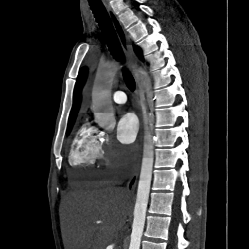 Cardiac tumor - undifferentiated pleomorphic sarcoma (Radiopaedia 45844-50134 B 38).png