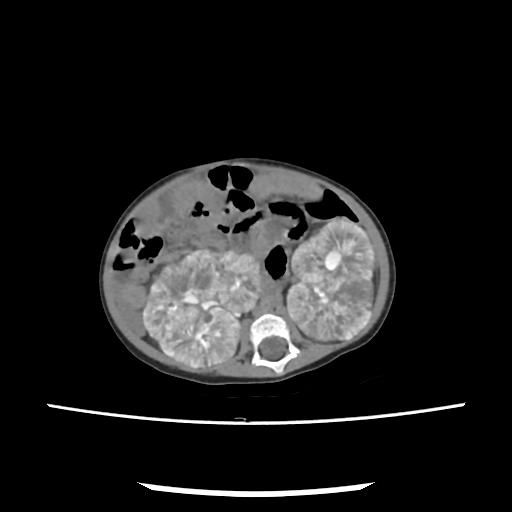 File:Caroli disease with autosomal recessive polycystic kidney disease (ARPKD) (Radiopaedia 89651-106703 E 126).jpg