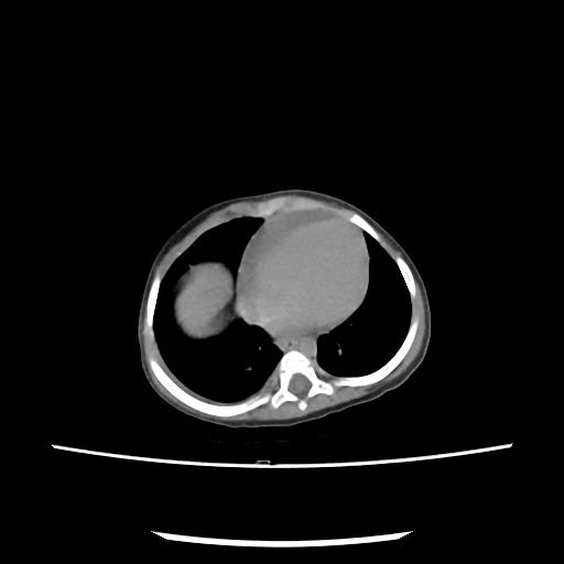 Caroli disease with autosomal recessive polycystic kidney disease (ARPKD) (Radiopaedia 89651-106703 E 7).jpg