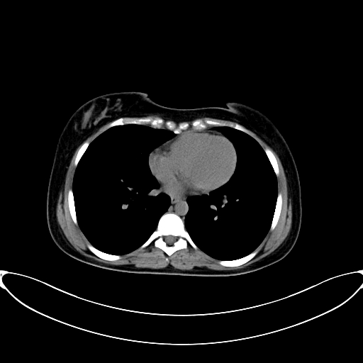 Caroli disease with medullary sponge kidney (Radiopaedia 82622-96804 Axial non-contrast 3).jpg