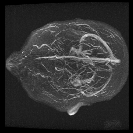 Carotid arterial dissection with acute cerebral infarction (Radiopaedia 26636-26784 MRV 10).jpg