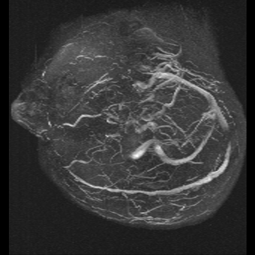 Carotid arterial dissection with acute cerebral infarction (Radiopaedia 26636-26784 MRV 15).jpg