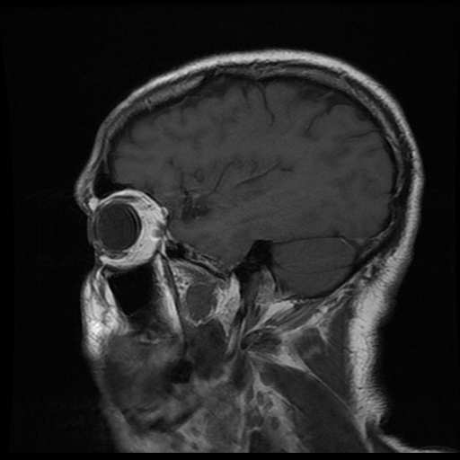 File:Carotid arterial dissection with acute cerebral infarction (Radiopaedia 26636-26784 Sagittal T1 C+ 4).jpg