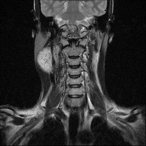 File:Carotid body tumor (Radiopaedia 30208-30823 Coronal T2 10).jpg