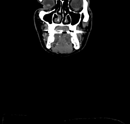 File:Carotid body tumor (Radiopaedia 83615-98727 B 16).jpg