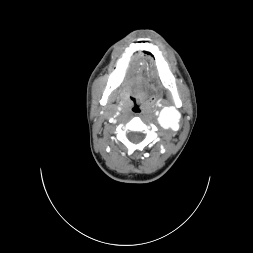 File:Carotid bulb pseudoaneurysm (Radiopaedia 57670-64616 A 22).jpg