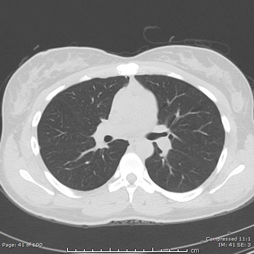 Catamenial pneumothorax (Radiopaedia 54382-60600 Axial non-contrast 41).jpg