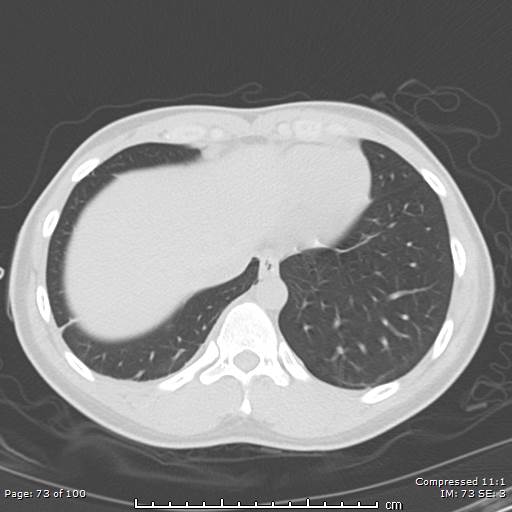Catamenial pneumothorax (Radiopaedia 54382-60600 Axial non-contrast 73).jpg