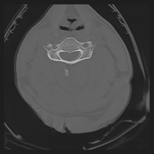 Cavernoma of cervical cord (Radiopaedia 50838-56346 Sagittal bone window 1).png