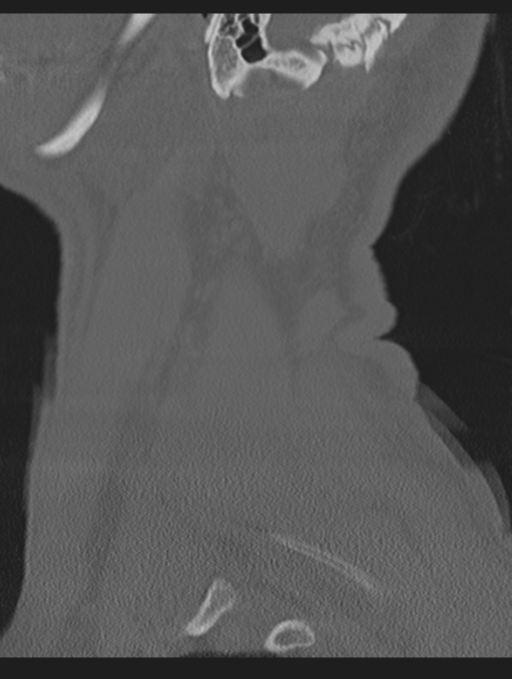 Cavernoma of cervical cord (Radiopaedia 50838-56346 Sagittal bone window 74).png