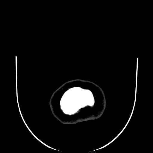 Cavernoma with developmental venous anomaly (Radiopaedia 22470-22506 C 208).jpg
